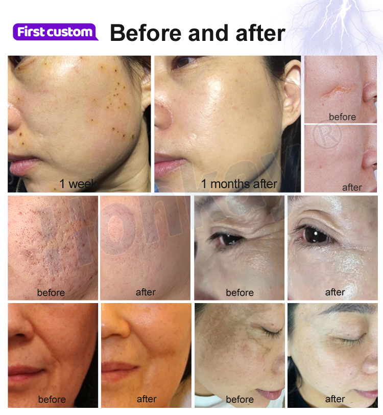 Cold plasma pen before after